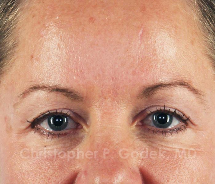 Eyelid Lift Before & After Image