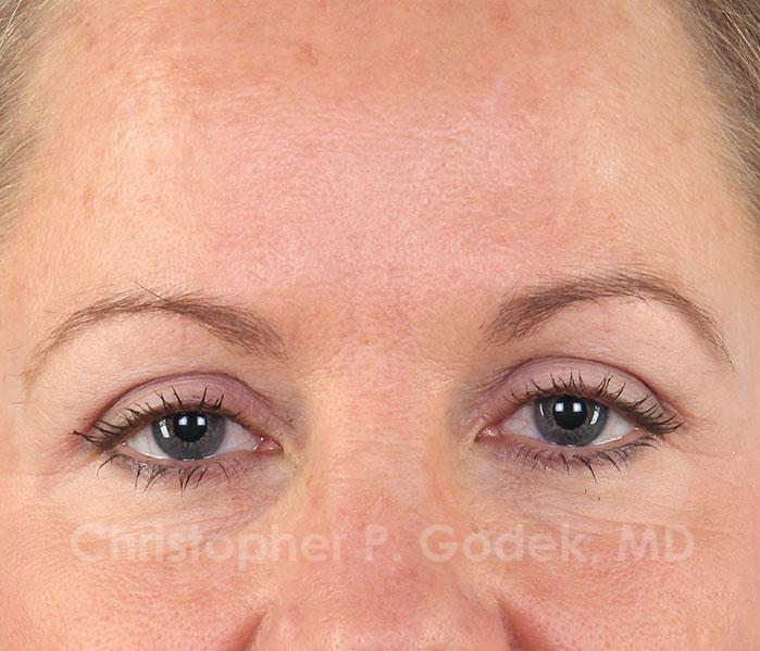 Eyelid Lift Before & After Image