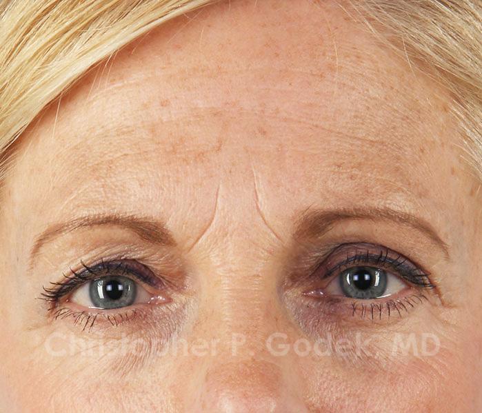 Eyelid Lift Before & After Image