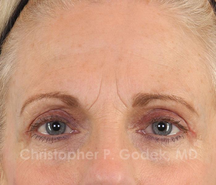 Eyelid Lift Before & After Image