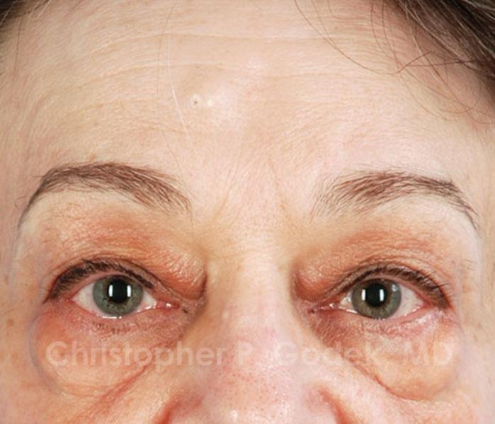 Eyelid Lift Before & After Image