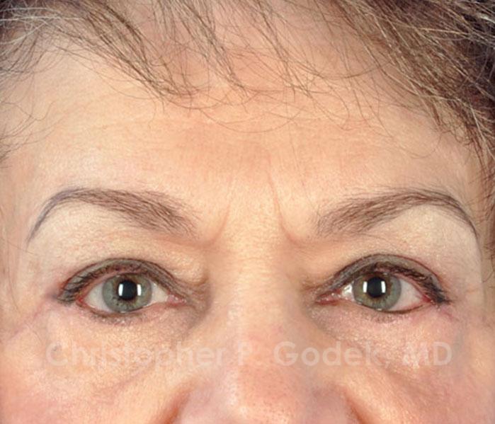 Eyelid Lift Before & After Image