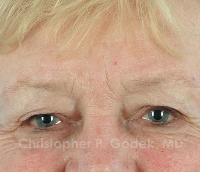 Eyelid Lift Before & After Image