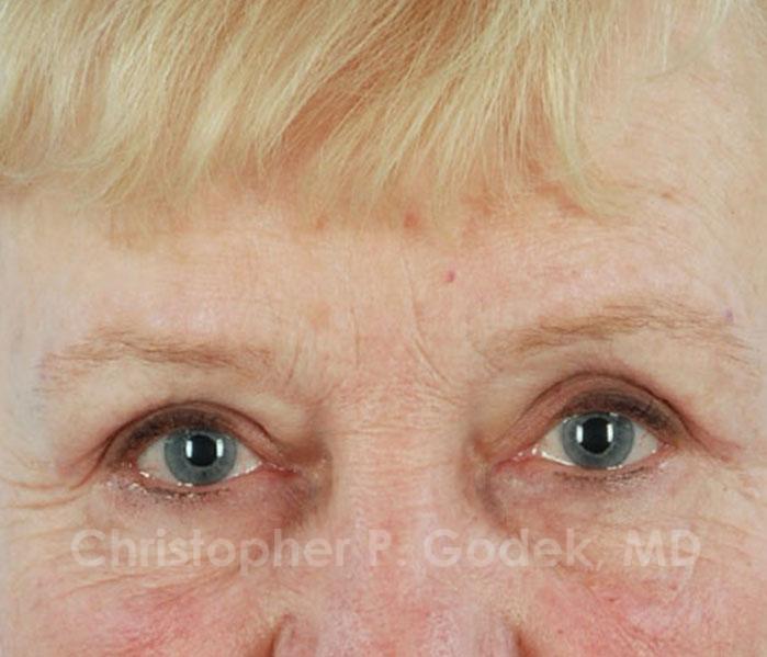 Eyelid Lift Before & After Image