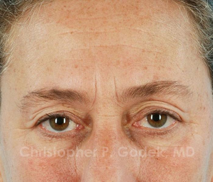 Eyelid Lift Before & After Image