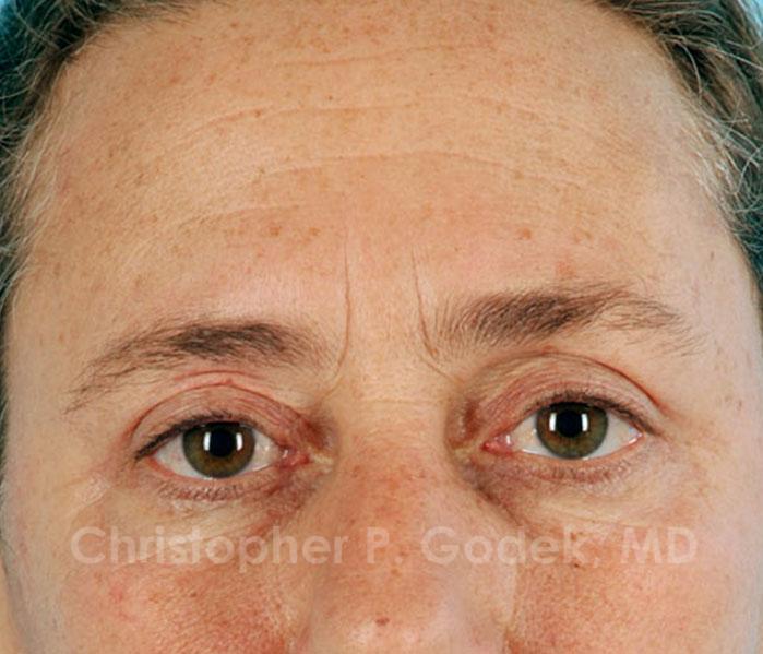 Eyelid Lift Before & After Image