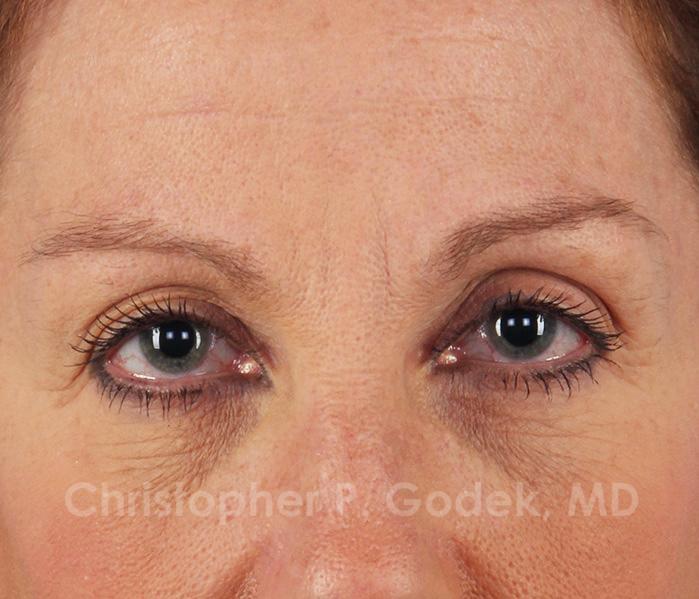 Eyelid Lift Before & After Image