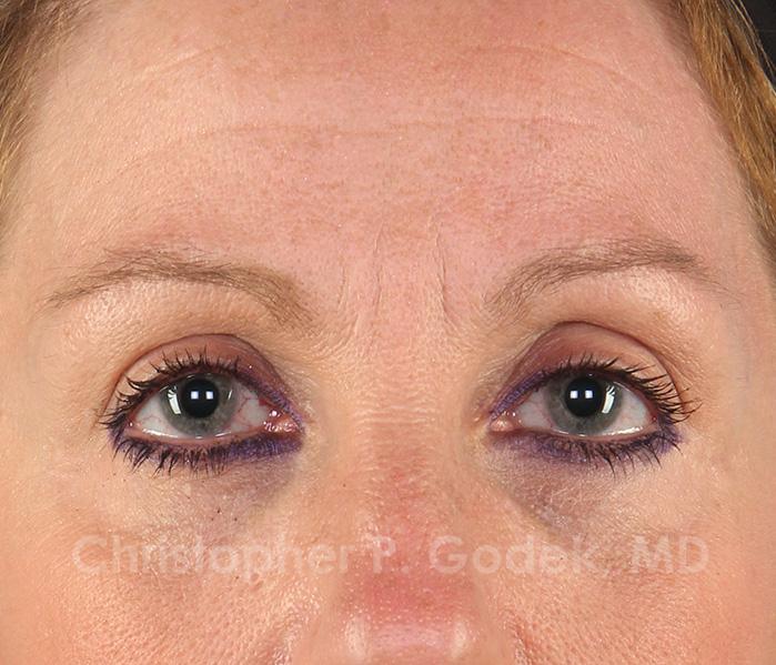 Eyelid Lift Before & After Image