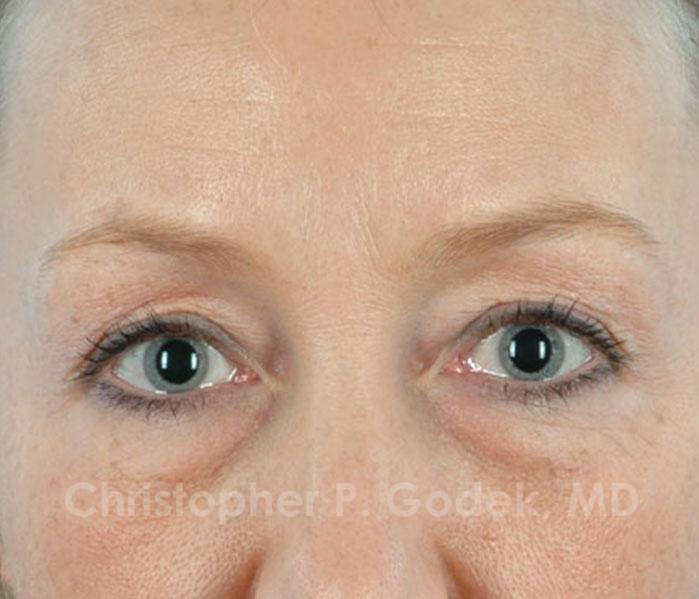 Eyelid Lift Before & After Image