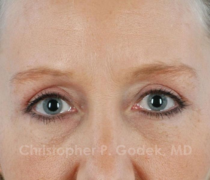 Eyelid Lift Before & After Image