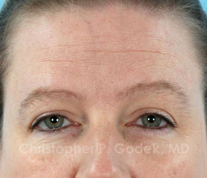 Eyelid Lift Before & After Image