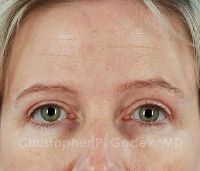 Eyelid Lift Before & After Image