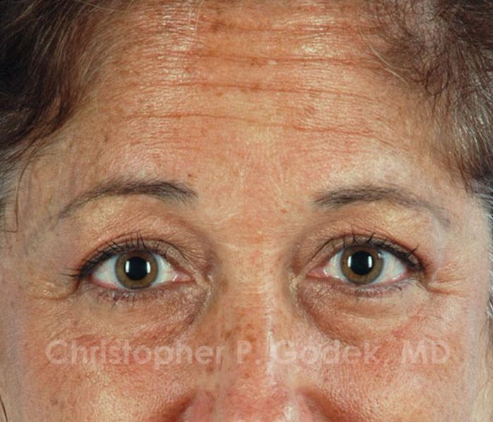 Eyelid Lift Before & After Image