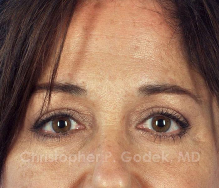 Eyelid Lift Before & After Image