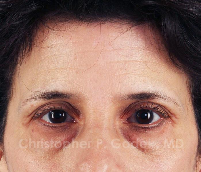 Eyelid Lift Before & After Image