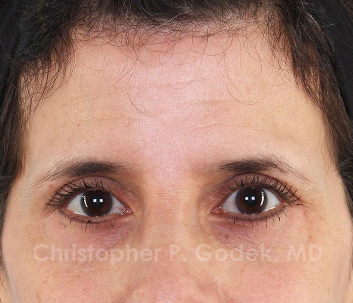 Eyelid Lift Before & After Image