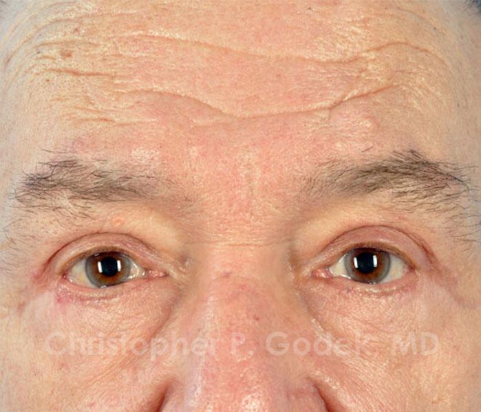 Eyelid Lift Before & After Image