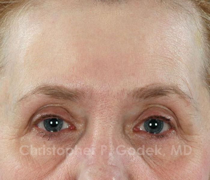 Eyelid Lift Before & After Image