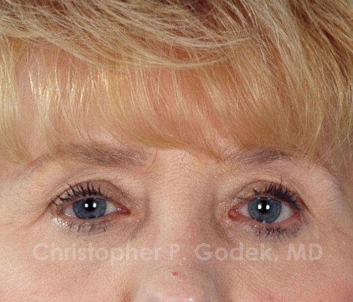 Eyelid Lift Before & After Image