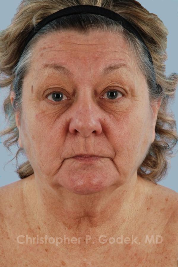 Facelift  Before & After Image