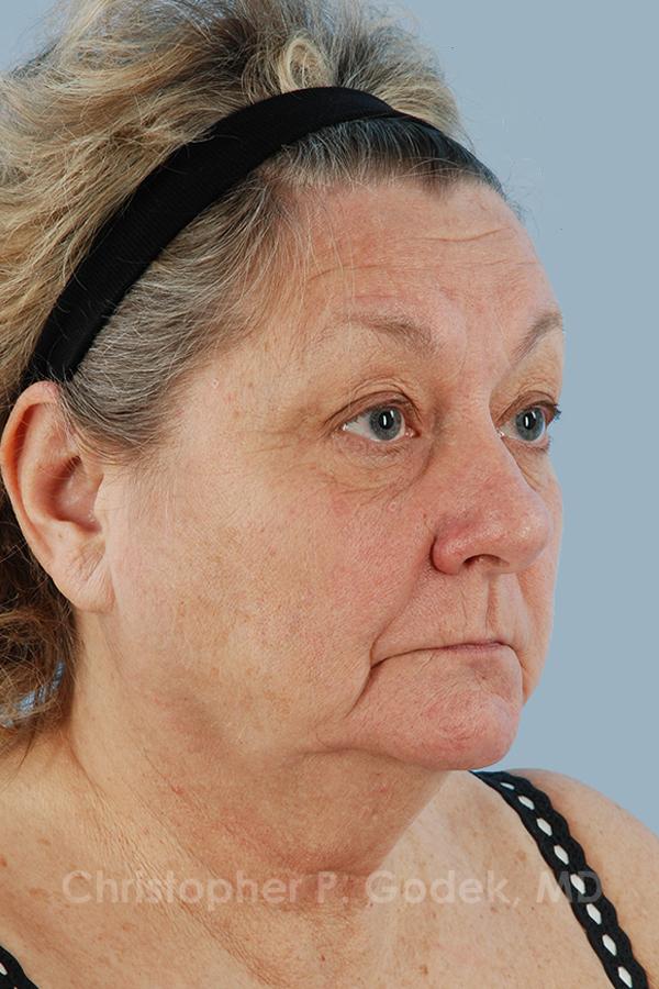 Facelift  Before & After Image