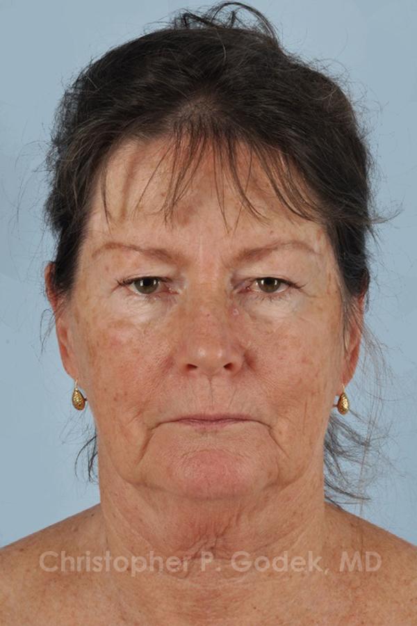 Facelift  Before & After Image