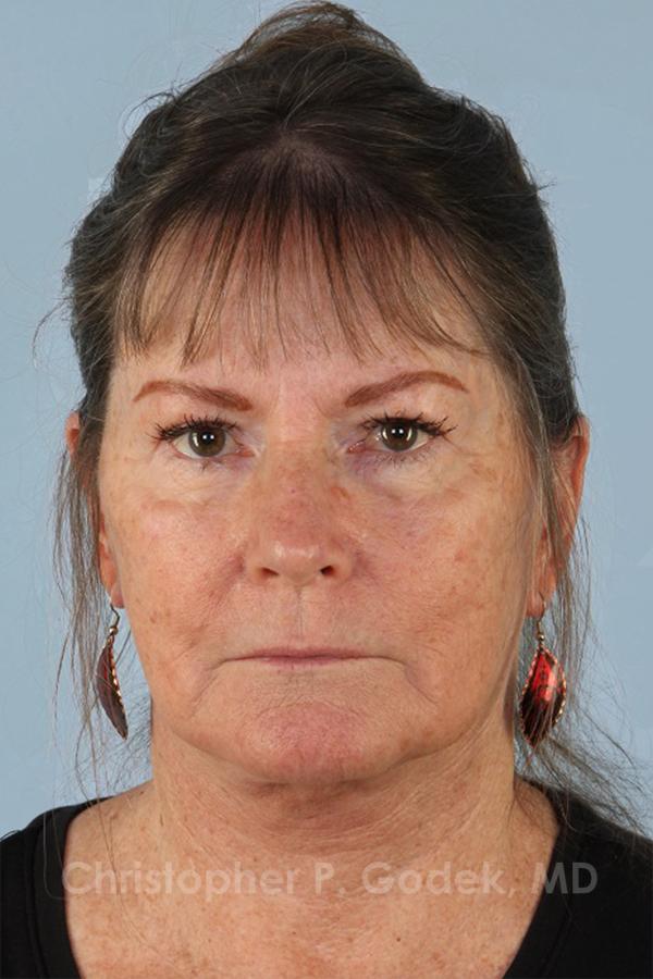 Facelift  Before & After Image