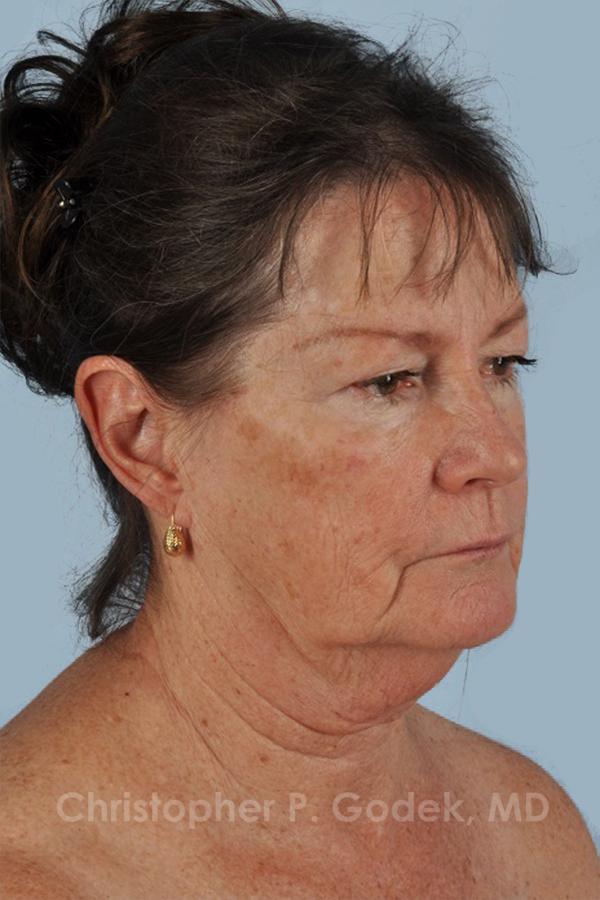 Facelift  Before & After Image