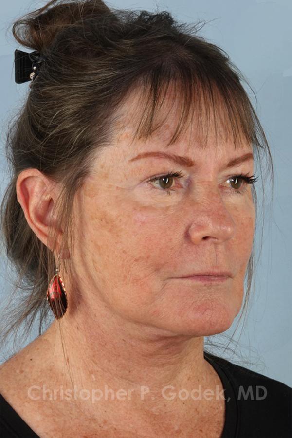 Facelift  Before & After Image