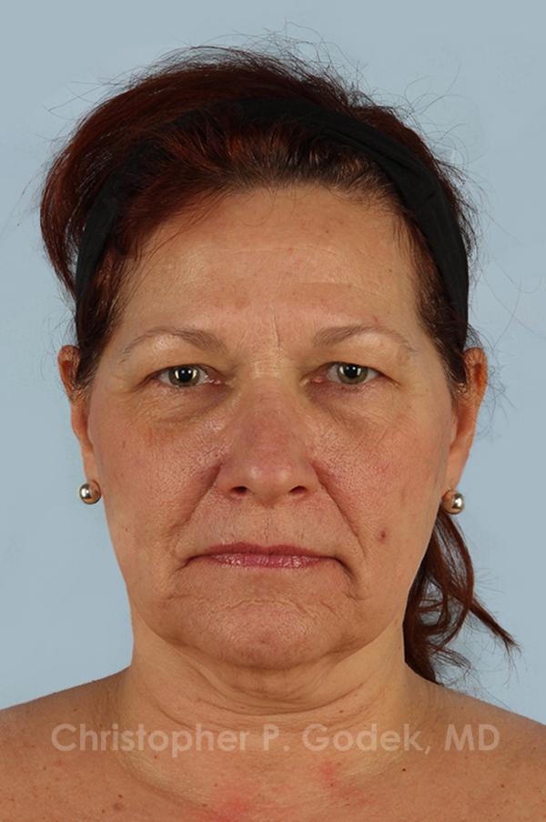 Facelift  Before & After Image