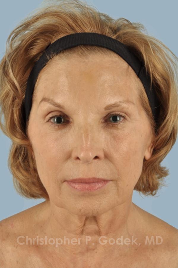 Facelift  Before & After Image