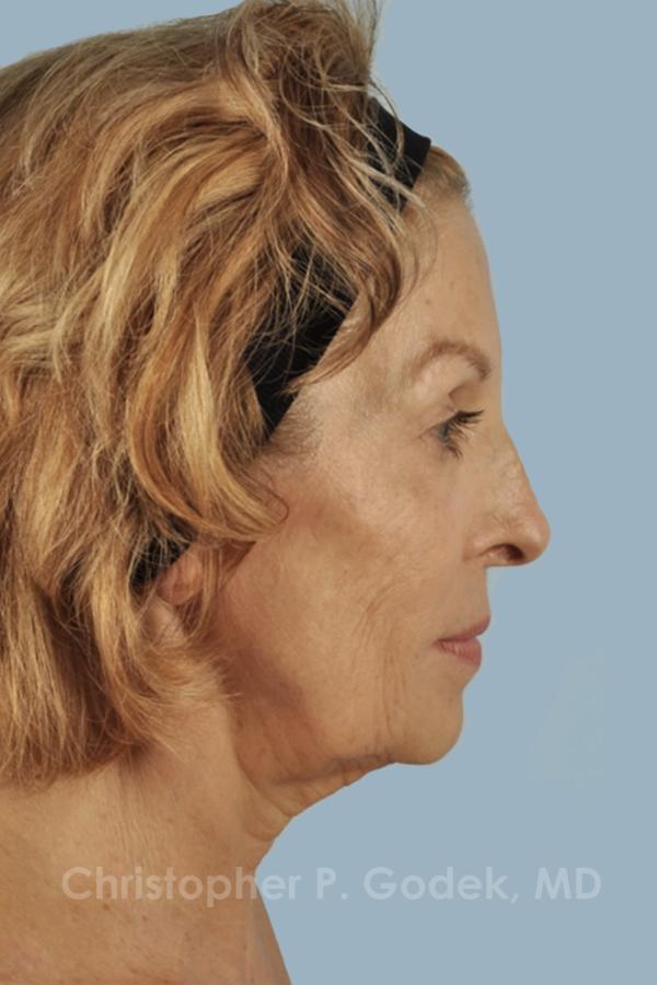 Facelift  Before & After Image