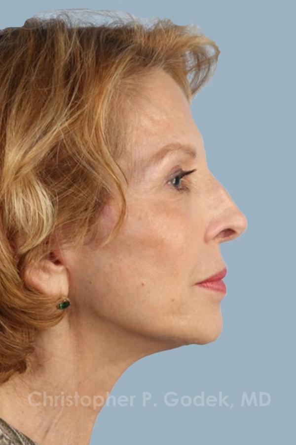 Facelift  Before & After Image