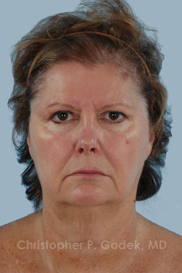 Facelift  Before & After Image