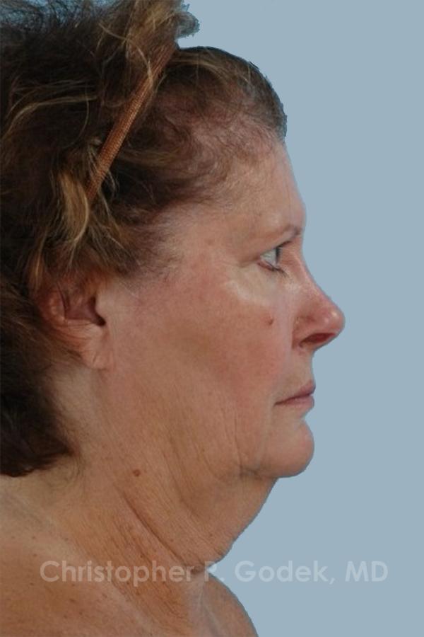 Facelift  Before & After Image