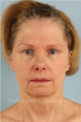 Facelift  Before & After Image