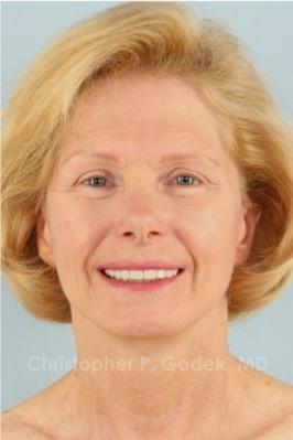 Facelift  Before & After Image