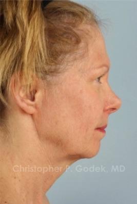 Facelift  Before & After Image