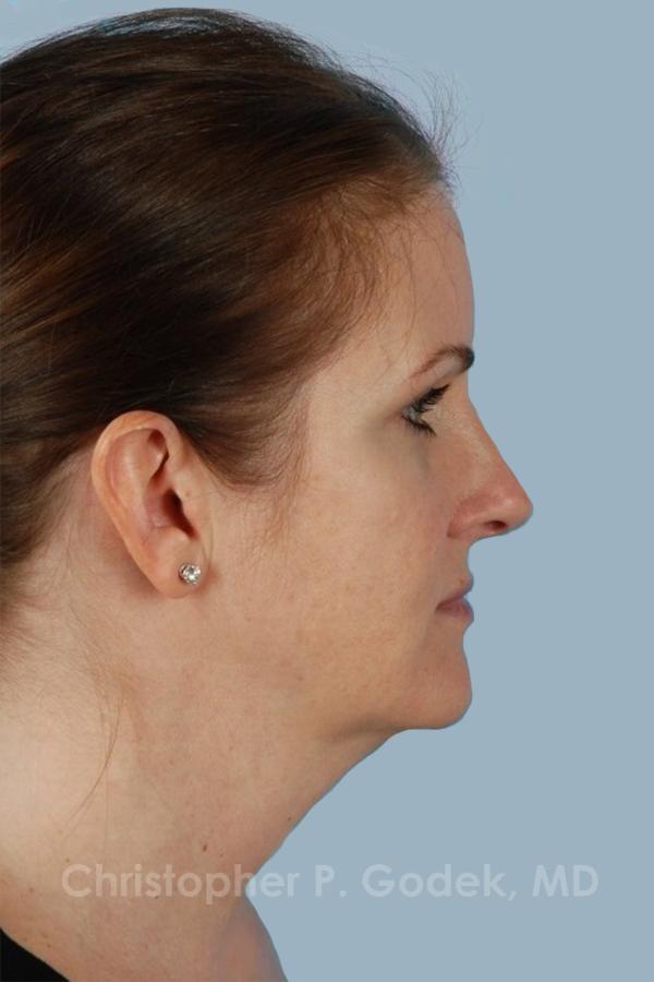 Facelift  Before & After Image