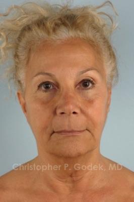 Facelift  Before & After Image