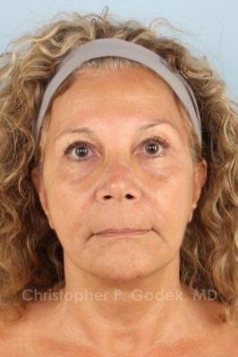 Facelift  Before & After Image