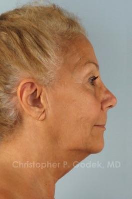 Facelift  Before & After Image