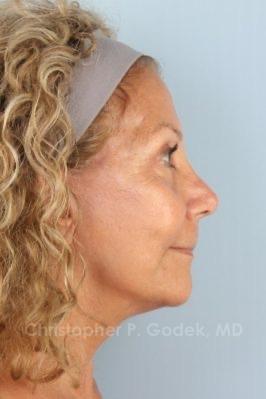 Facelift  Before & After Image