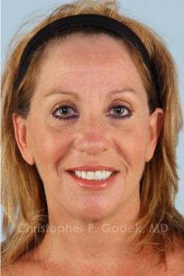 Facelift  Before & After Image