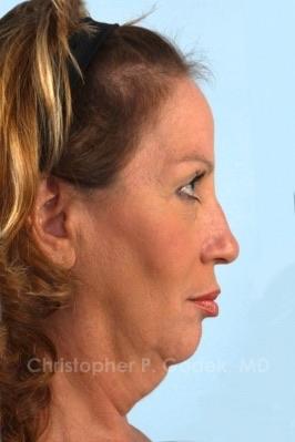 Facelift  Before & After Image