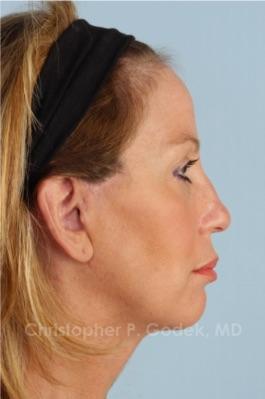 Facelift  Before & After Image