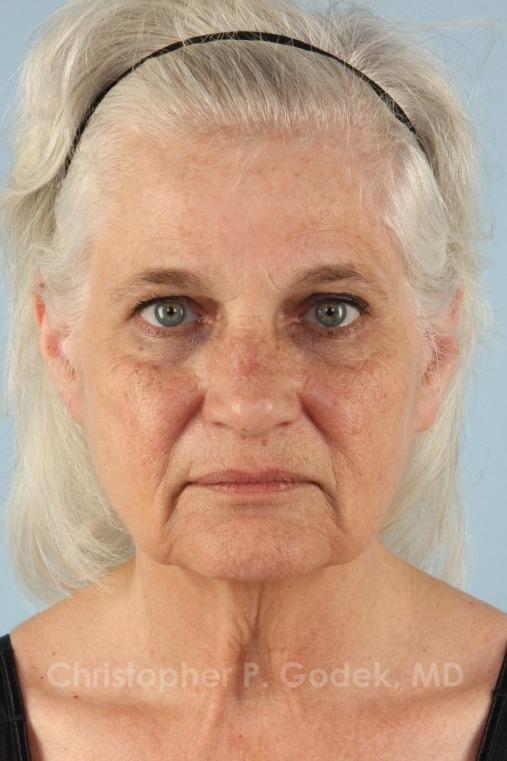 Facelift  Before & After Image