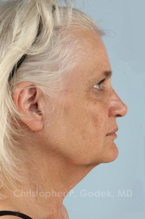 Facelift  Before & After Image