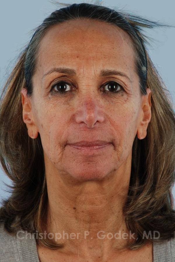 Facelift  Before & After Image