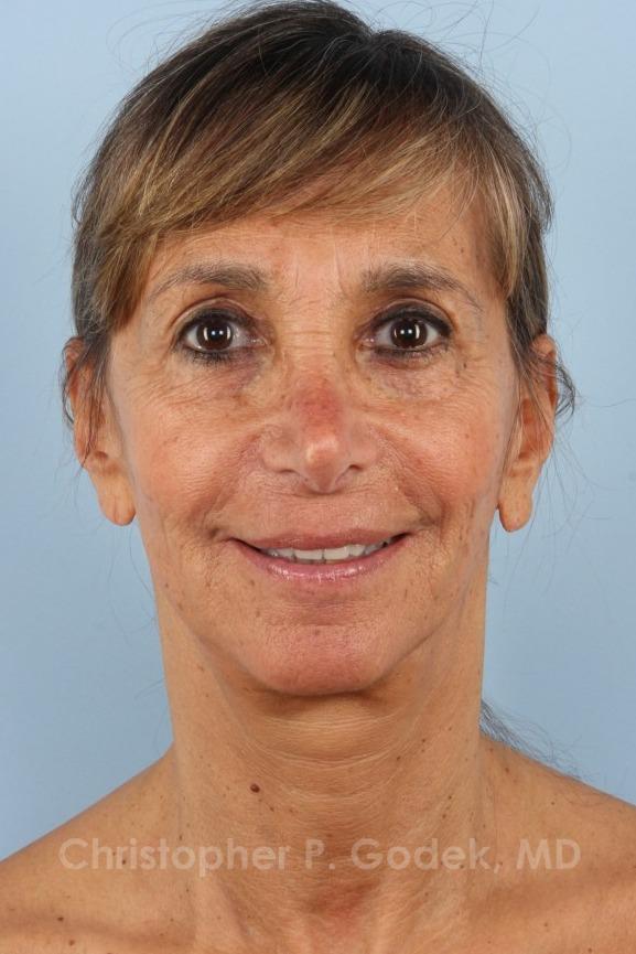 Facelift  Before & After Image